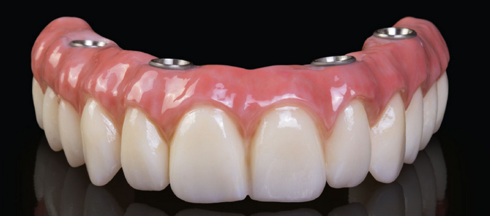 All on 4® implant and zirconia bridge